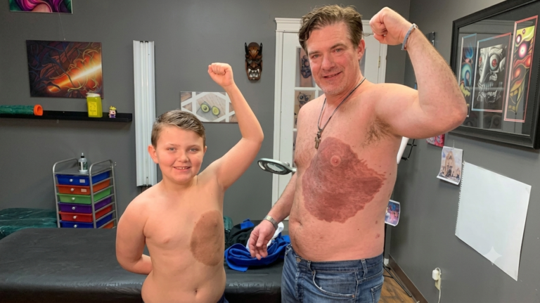 A DAD SAT THROUGH 30 HOURS OF TATTOO PAIN TO COPY HIS SON’S BIRTHMARK SO THE BOY WOULDN’T FEEL ALONE